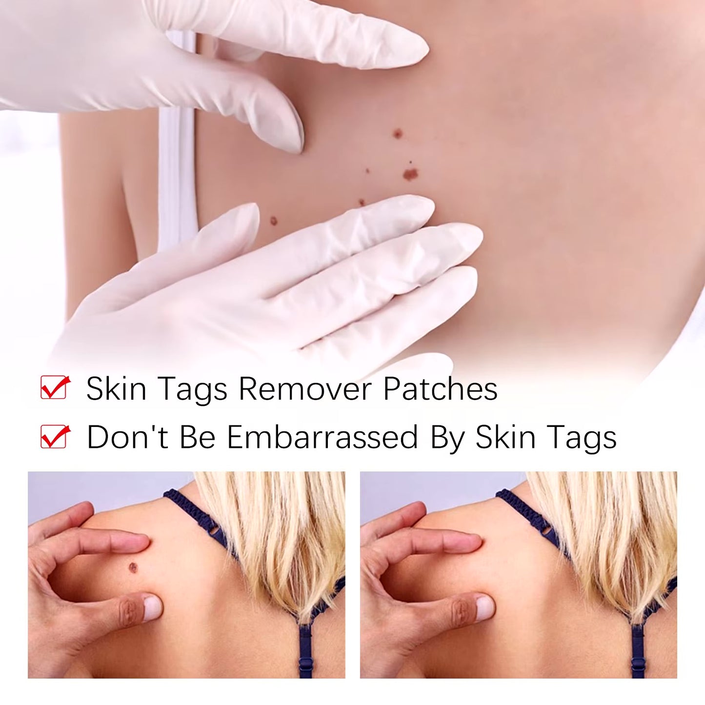 JaySuing TagFree™ | Painless Skin Tag Removal