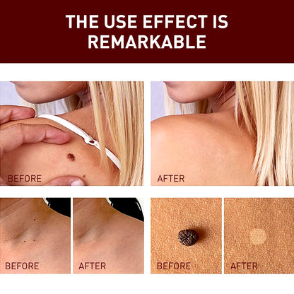 JaySuing TagFree™ | Painless Skin Tag Removal