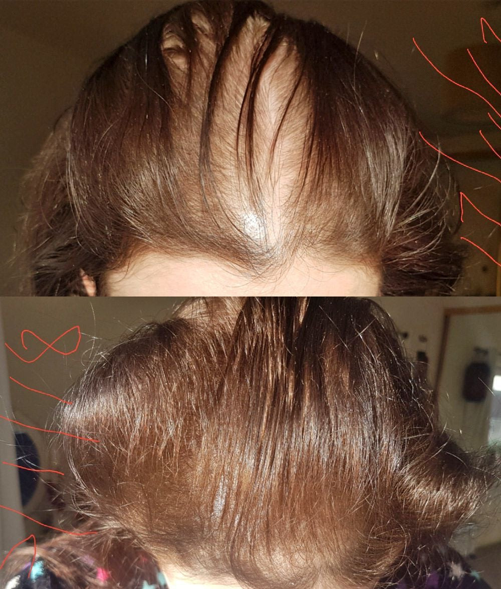 BatanaBoost™ | Revitalizes Thinning Hair Naturally (with FREE Batana Essential Oil worth $40,00)